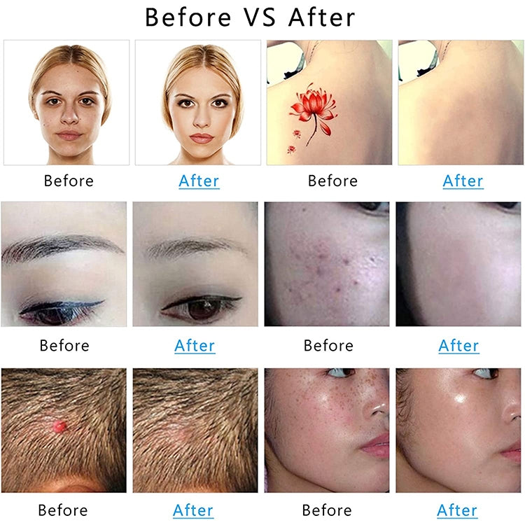 AA-A401 Small Freckle and Mole Removal Pen Tattoo and Eyebrow Removal Beauty Instrument, Color: Blu-ray Battery by bashfashion